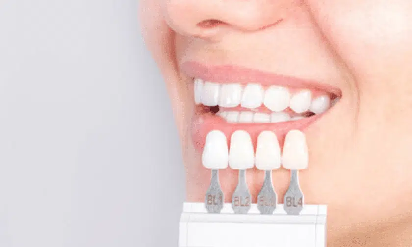 Dental veneers