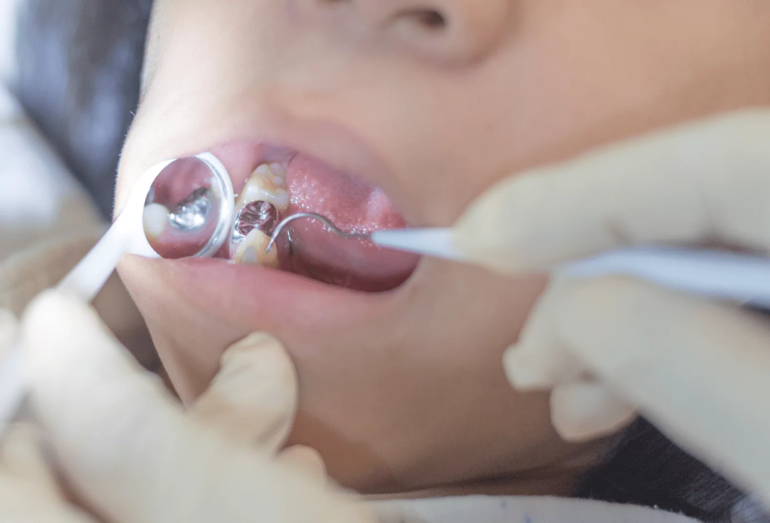 Dental Fillings in Ventura