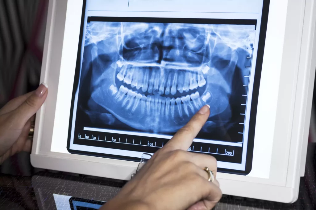 Dental X-Rays in Ventura