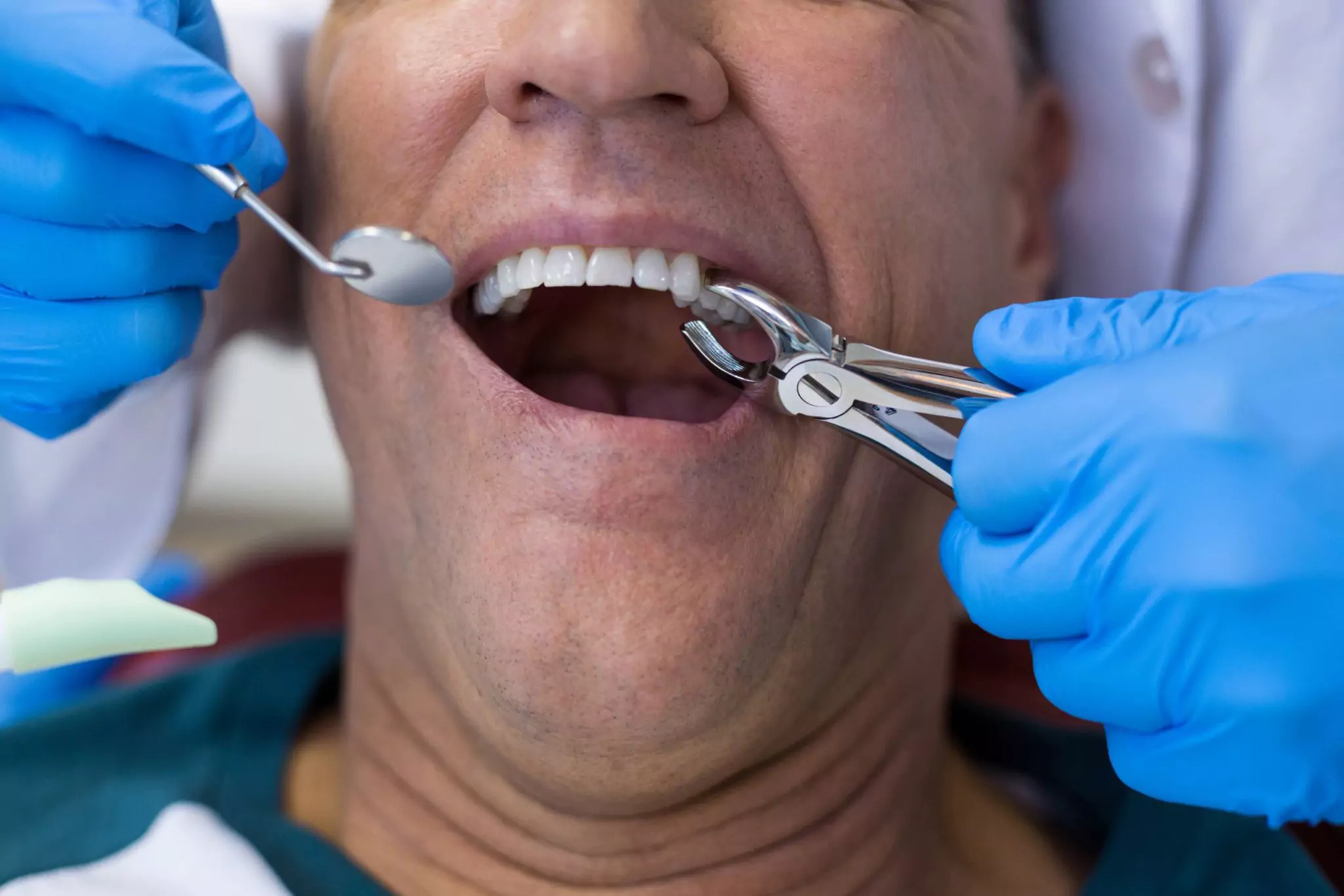 Dental Extraction in Ventura