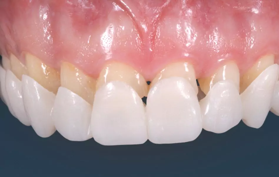 Dental Veneers