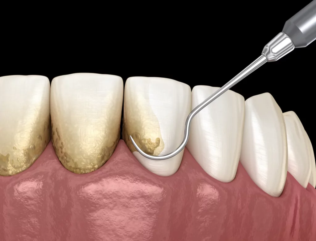 teeth cleaning treatment