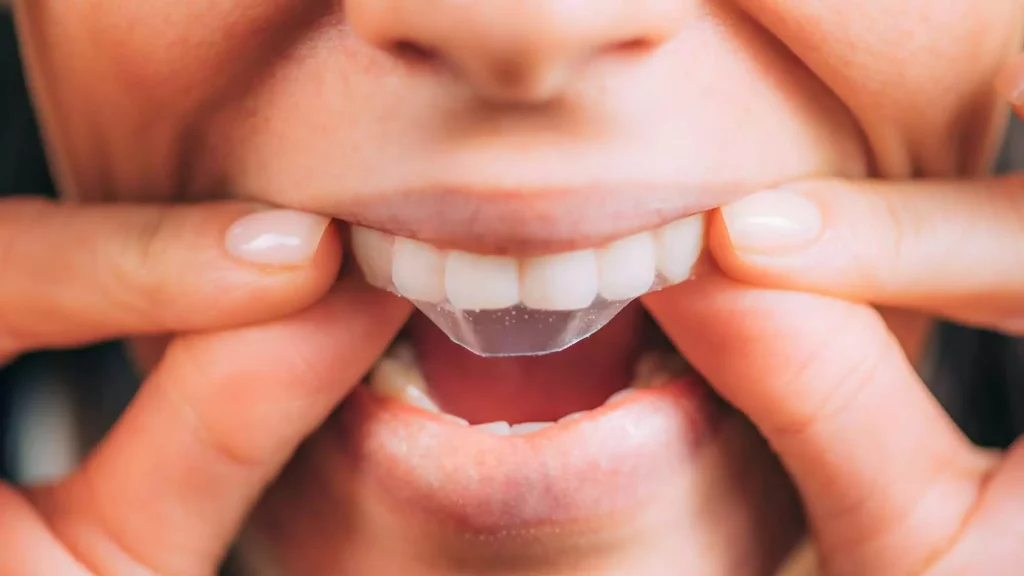 Invisalign Aligners