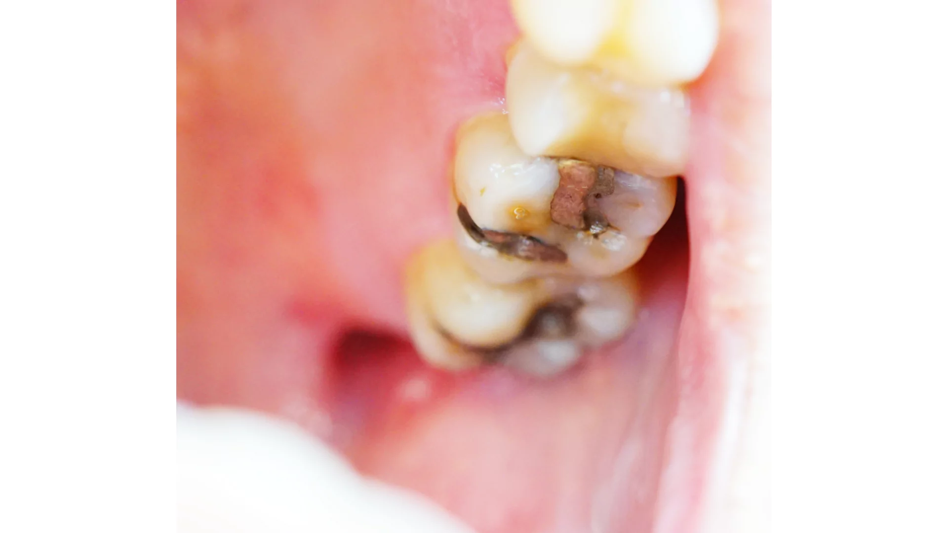 gold amalgam for teeth