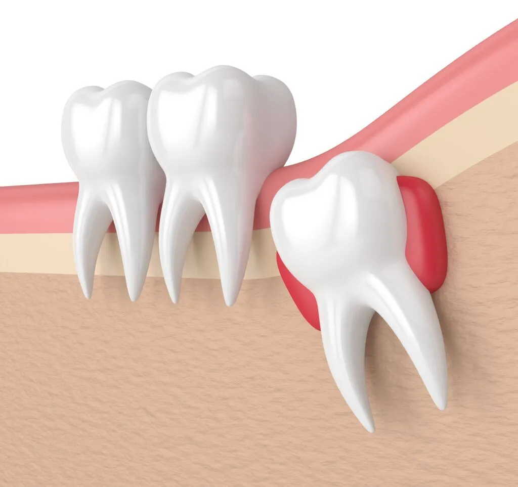 Wisdom Tooth extraction in Ventura,wisdom tooth extraction,ventura,wisdom tooth removal