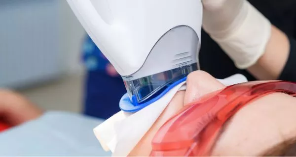 Laser Teeth Whitening Estimated Costs for Laser Whitening in Ventura, CA