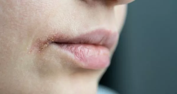 Recognizing the symptoms of drug-induced xerostomia