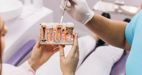 root canal treatment in ventura,root canal What is a root canal?