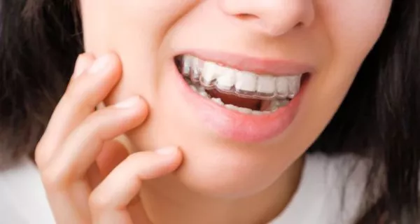 invisalign, invisalign in ventura Benefits of Invisalign