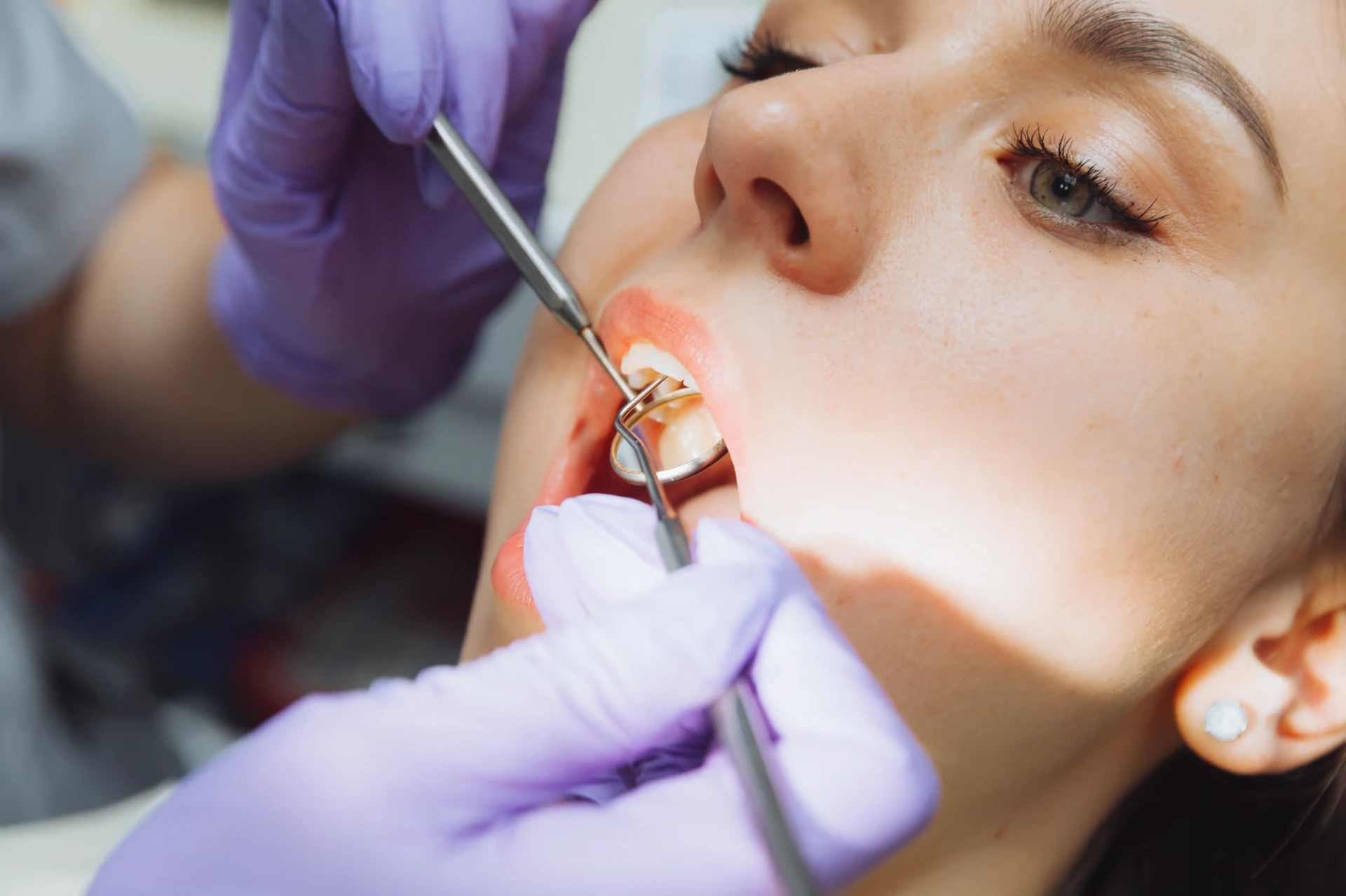 Rellenos Dentales en Ventura
